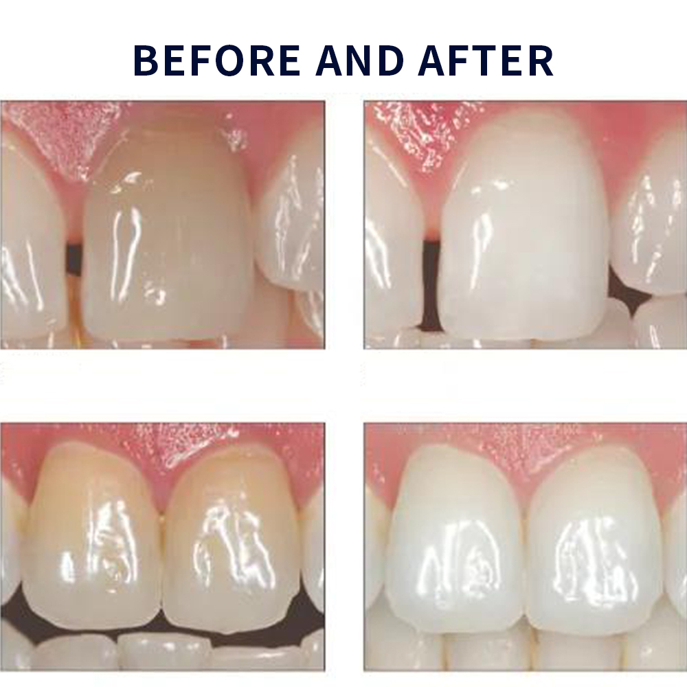 Opalescentie Whitening 20% Pf  - Teeth Whitening Near Me recensie en prijs