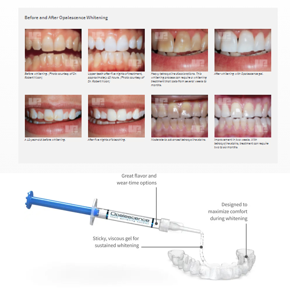 Opalescentie Whitening 20% Pf  - Teeth Whitening Near Me recensie en prijs