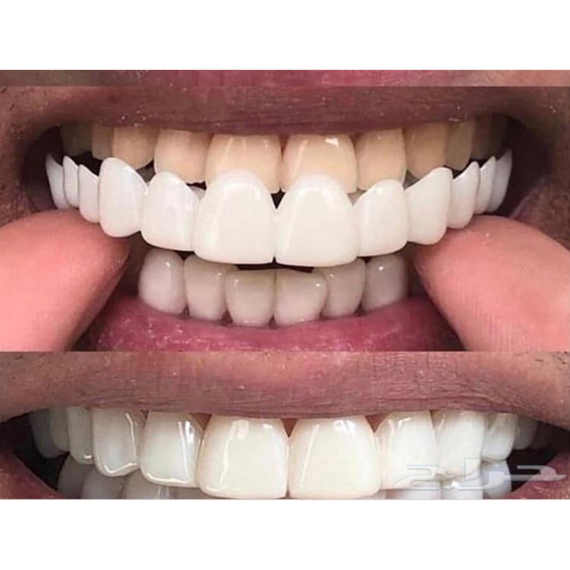 Zachte Siliconen Gel Dental Or - Teeth Whitening Moulds recensie en prijs