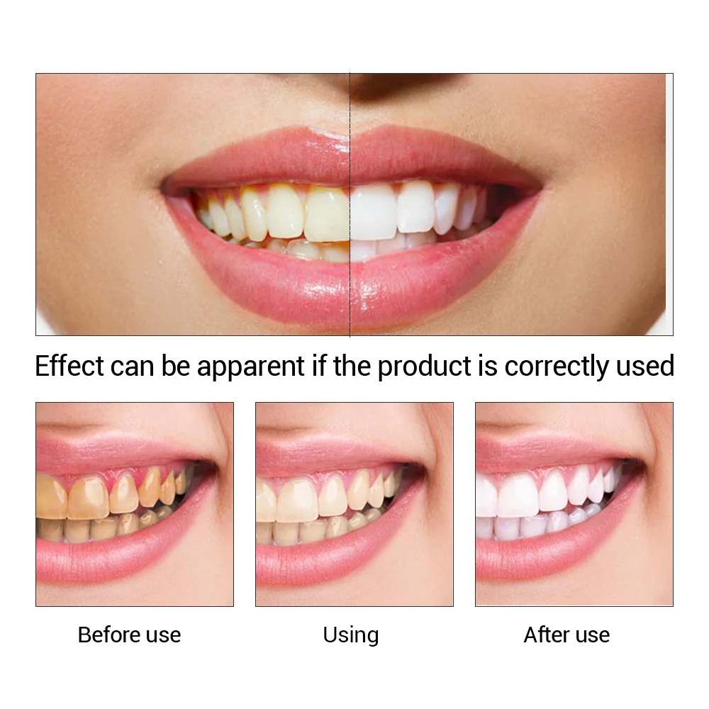 Fteenply Tanden Whitening Esse - Teeth Whitening Near Me recensie en prijs