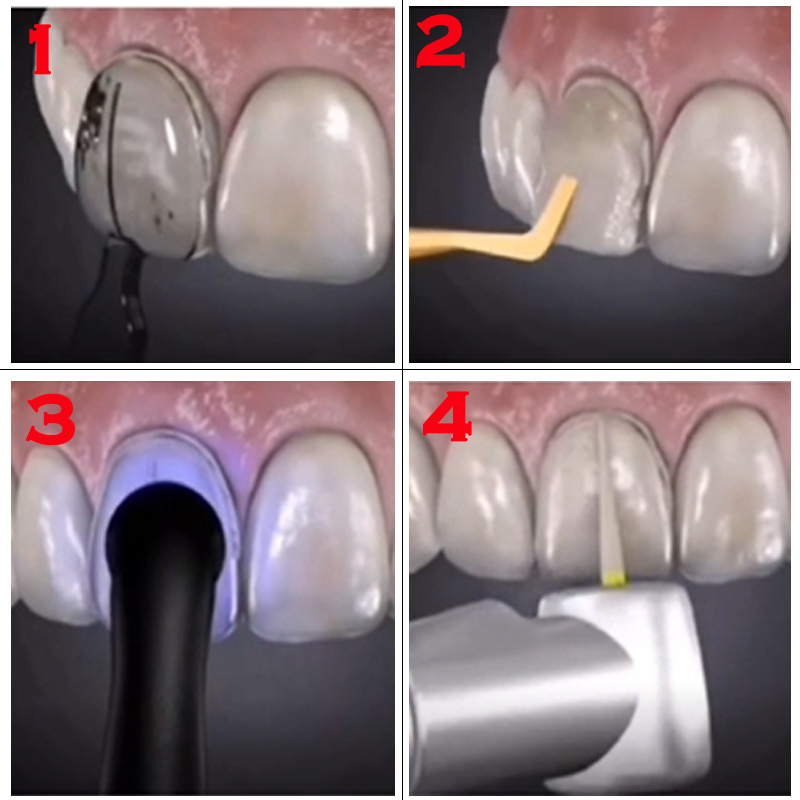 32-delige tandenbleekmal, tand - Teeth Whitening Moulds recensie en prijs