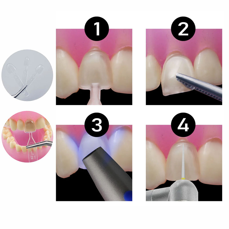 32 stks/set Composiet Hars Mal - Teeth Whitening Moulds recensie en prijs
