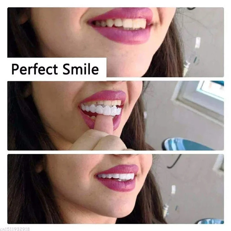 Snap-on Veneer Tanden Kit Vers - Teeth Whitening Kit recensie en prijs