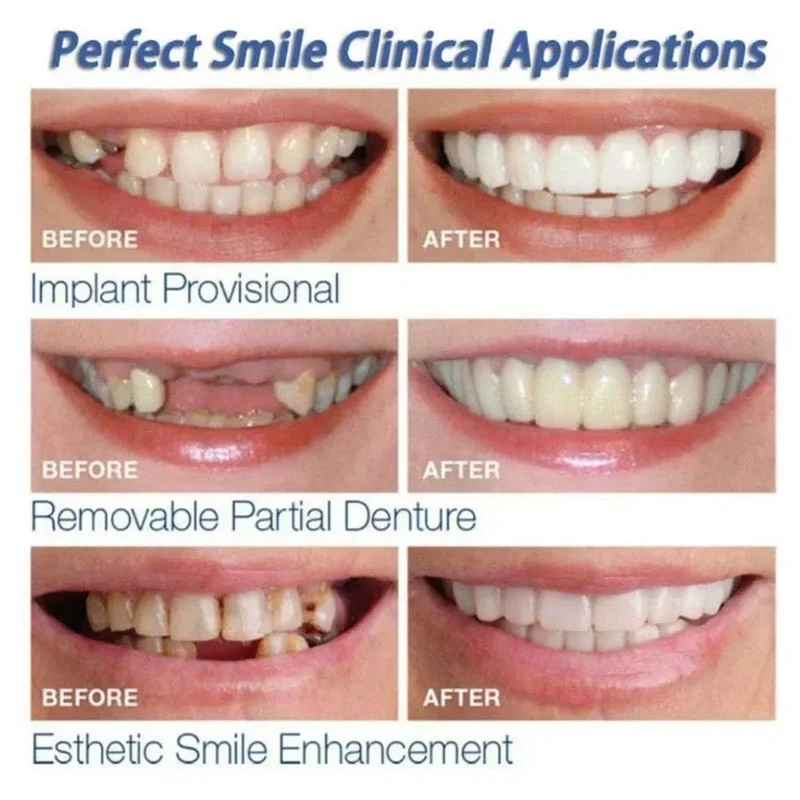 Snap-on Veneer Tanden Kit Vers - Teeth Whitening Kit recensie en prijs