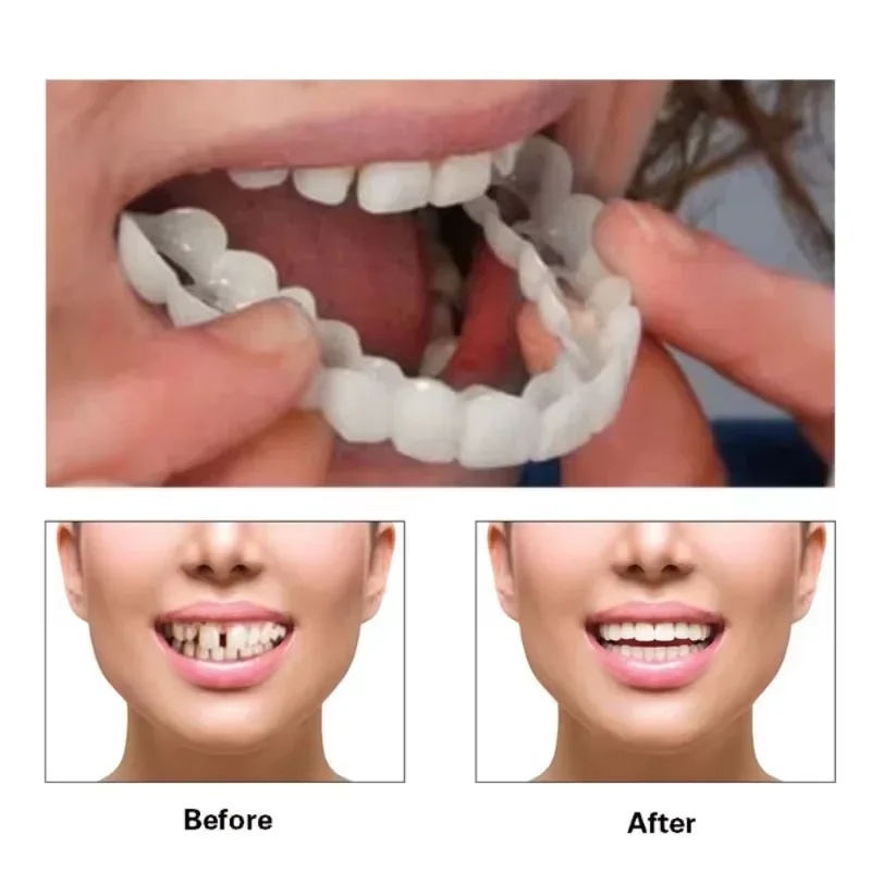 Snap-on Veneer Tanden Kit Vers - Teeth Whitening Kit recensie en prijs